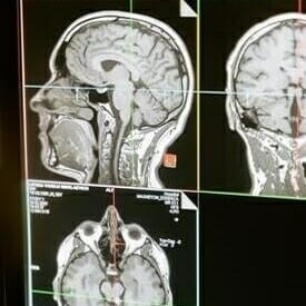 What Is the Average Payout for a Head Injury?