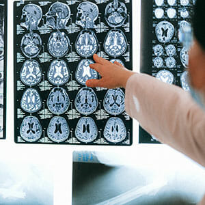 How Much Does a Brain Injury Cost?