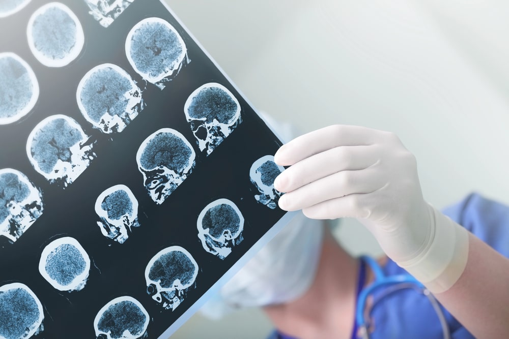 Doctor reviewing brain scan images for an Anchorage brain injury claim.